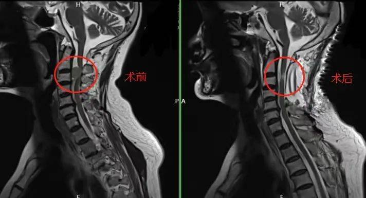 肢体麻痛、走路不稳，不可忽视这一区域的肿瘤！