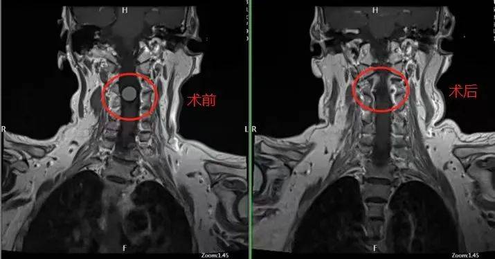 肢体麻痛、走路不稳，不可忽视这一区域的肿瘤！